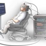 Νευροπροσθετική συσκευή «διαβάζει» τον εγκέφαλο και ξαναδίνει «φωνή» σε άνθρωπο με παράλυση ομιλίας